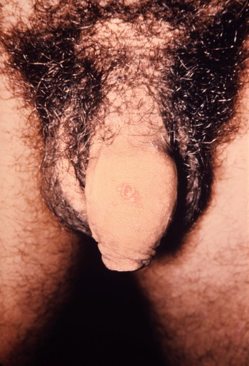 Lichen planus